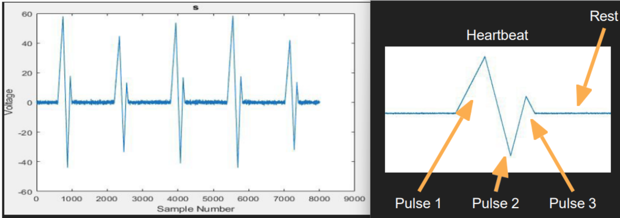EKG heartbeat compression